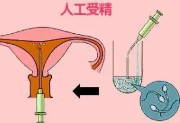 人工授精费用要多少钱？哪些因素会影响人工授精的成功率？