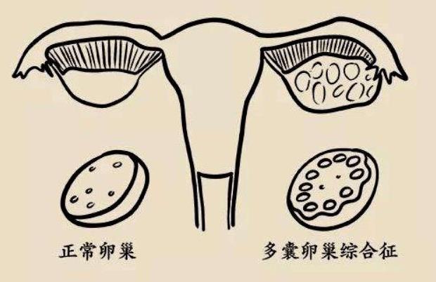 多囊卵巢综合征能生孩子吗？除了试管婴儿，你还需要做这些？