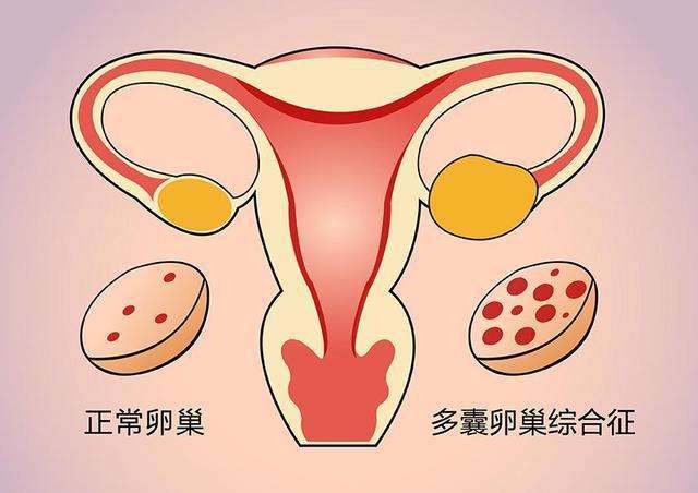 多囊卵巢综合症促排后可以怀孕吗？