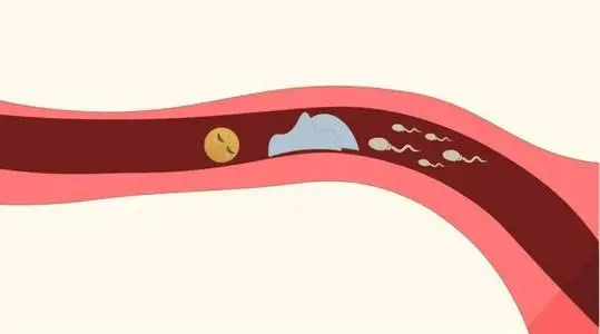 输卵管堵塞病因？医生告诉你输卵管堵塞症状