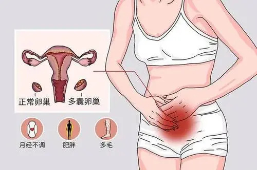 多囊需要降调吗？多囊降调和不降调的区别是什么？
